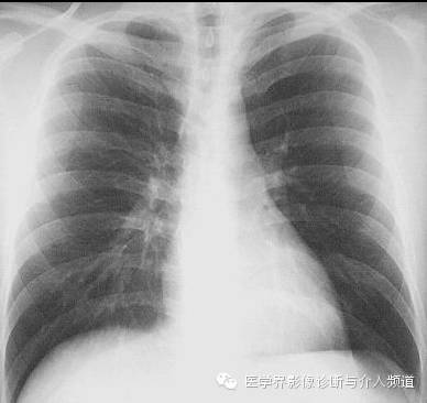 【病例】纵隔积气1例X线影像表现 【病例】纵隔积气1例X线影像表现