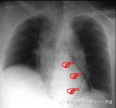 【病例】纵隔积气1例X线影像表现 【病例】纵隔积气1例X线影像表现