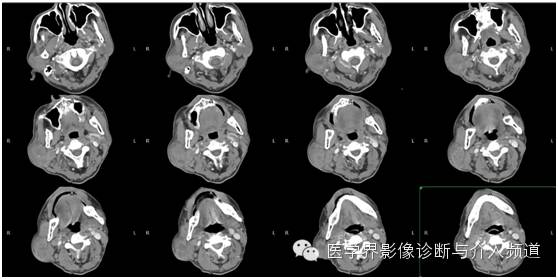 【病例】腮腺多形性腺瘤1例CT影像表现