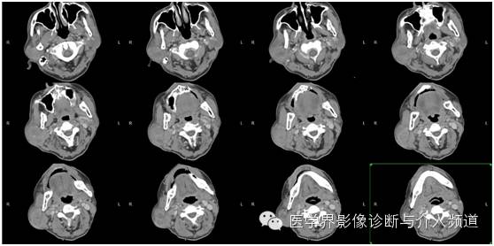 【病例】腮腺多形性腺瘤1例CT影像表现 【病例】腮腺多形性腺瘤1例CT影像表现