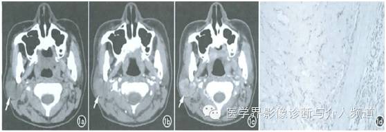 【病例】腮腺多形性腺瘤1例CT影像表现 【病例】腮腺多形性腺瘤1例CT影像表现