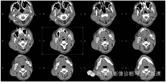 【病例】腮腺多形性腺瘤1例CT影像表现 【病例】腮腺多形性腺瘤1例CT影像表现