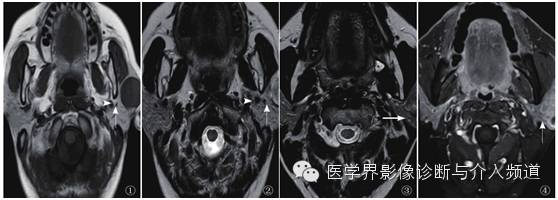 【病例】腮腺多形性腺瘤1例CT影像表现