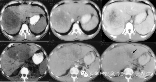 纤维板层型肝癌FL-HCC与肝脏局灶性结节增生FNH的鉴别诊断 纤维板层型肝癌FL-HCC与肝脏局灶性结节增生FNH的鉴别诊断