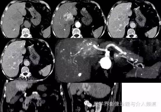 纤维板层型肝癌FL-HCC与肝脏局灶性结节增生FNH的鉴别诊断 纤维板层型肝癌FL-HCC与肝脏局灶性结节增生FNH的鉴别诊断