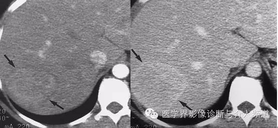 纤维板层型肝癌FL-HCC与肝脏局灶性结节增生FNH的鉴别诊断 纤维板层型肝癌FL-HCC与肝脏局灶性结节增生FNH的鉴别诊断