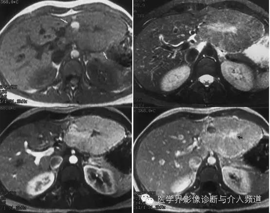 纤维板层型肝癌FL-HCC与肝脏局灶性结节增生FNH的鉴别诊断 纤维板层型肝癌FL-HCC与肝脏局灶性结节增生FNH的鉴别诊断