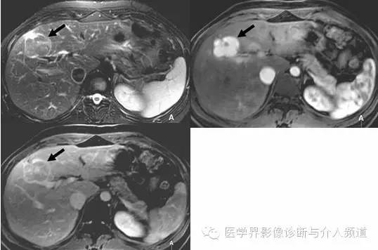 纤维板层型肝癌FL-HCC与肝脏局灶性结节增生FNH的鉴别诊断 纤维板层型肝癌FL-HCC与肝脏局灶性结节增生FNH的鉴别诊断