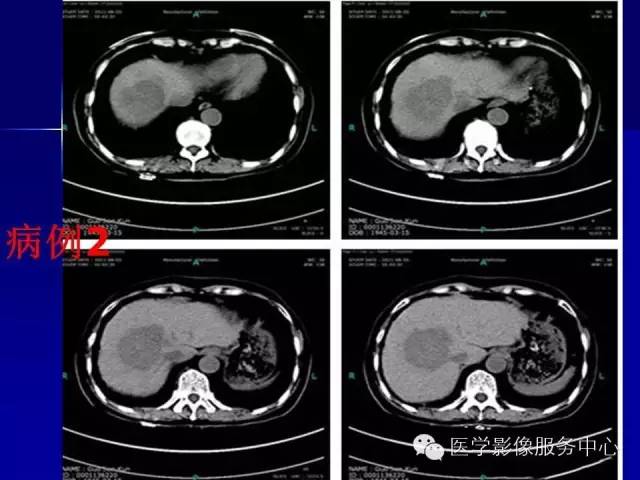 【病例】肝内胆管细胞癌1例CT影像表现与鉴别