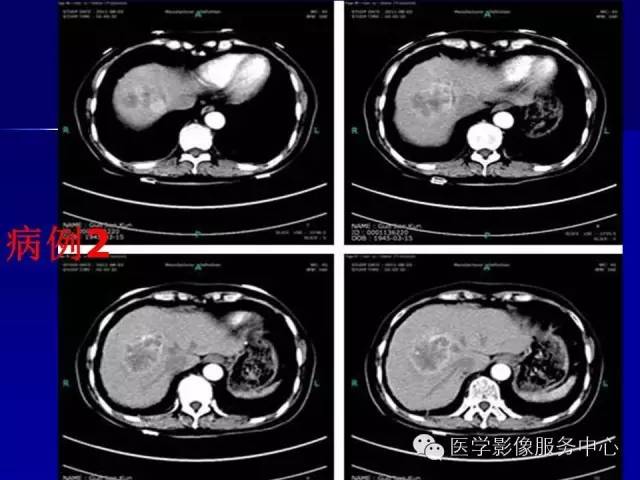 【病例】肝内胆管细胞癌1例CT影像表现与鉴别