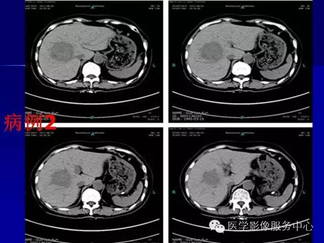 【病例】肝内胆管细胞癌1例CT影像表现与鉴别