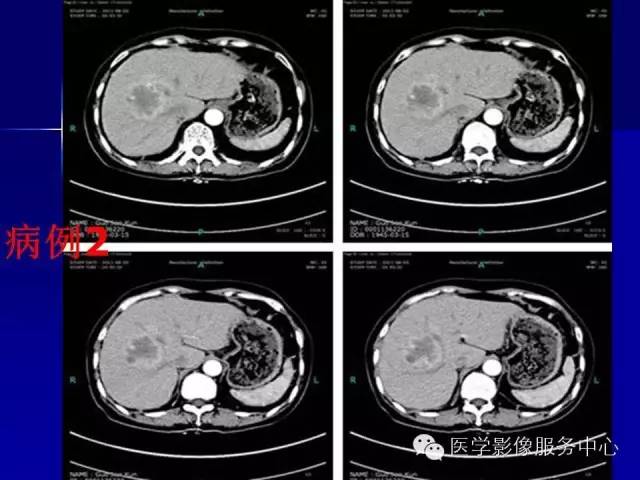 【病例】肝内胆管细胞癌1例CT影像表现与鉴别