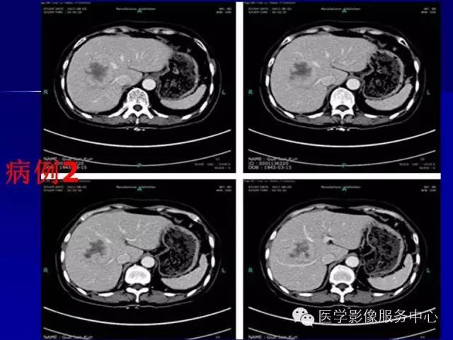 【病例】肝内胆管细胞癌1例CT影像表现与鉴别