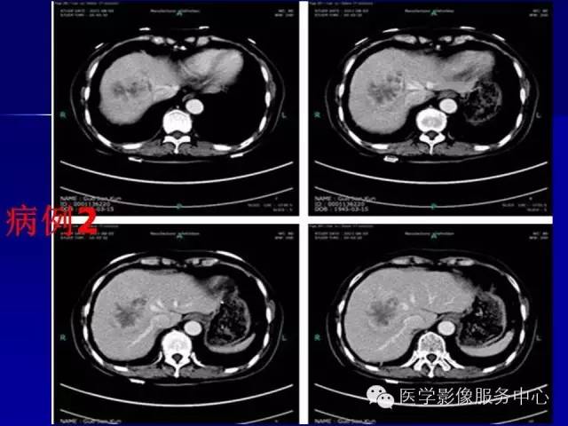 【病例】肝内胆管细胞癌1例CT影像表现与鉴别