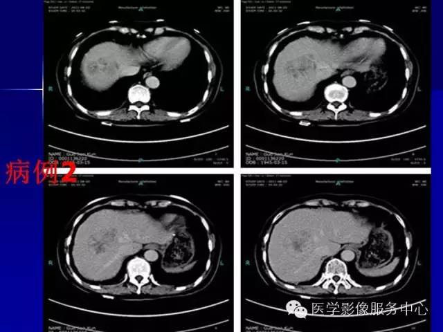 【病例】肝内胆管细胞癌1例CT影像表现与鉴别