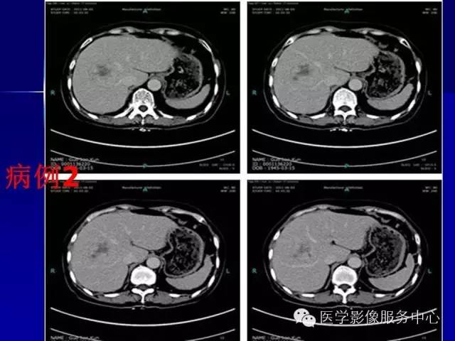 【病例】肝内胆管细胞癌1例CT影像表现与鉴别