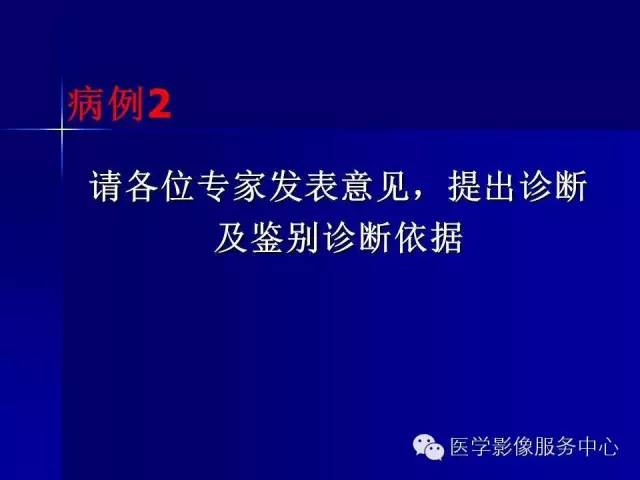 【病例】肝内胆管细胞癌1例CT影像表现与鉴别