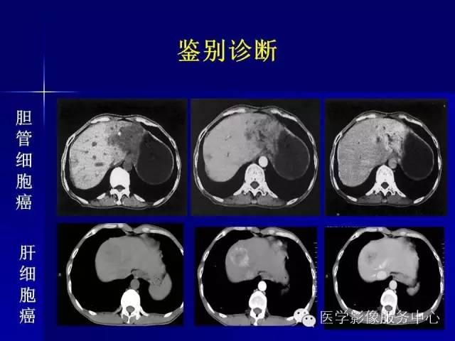 【病例】肝内胆管细胞癌1例CT影像表现与鉴别