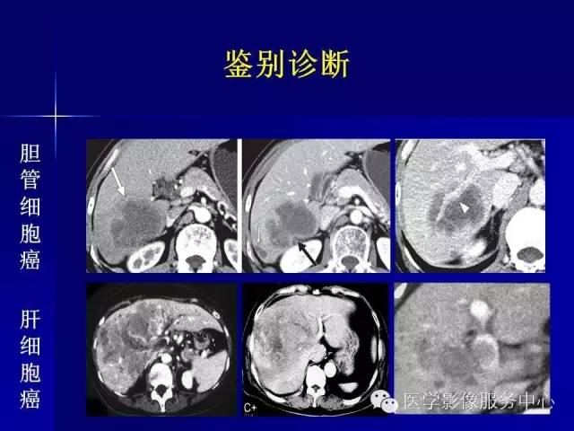 【病例】肝内胆管细胞癌1例CT影像表现与鉴别