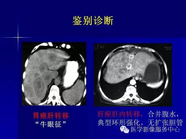 【病例】肝内胆管细胞癌1例CT影像表现与鉴别