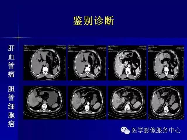 【病例】肝内胆管细胞癌1例CT影像表现与鉴别