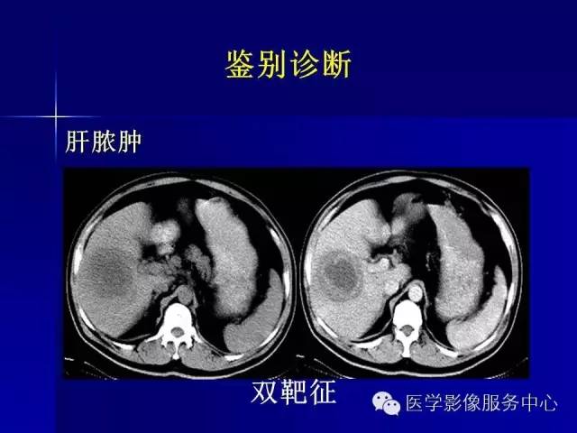 【病例】肝内胆管细胞癌1例CT影像表现与鉴别
