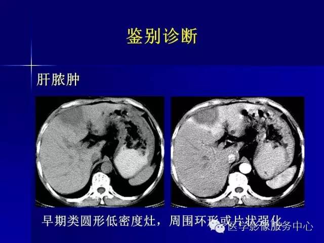 【病例】肝内胆管细胞癌1例CT影像表现与鉴别