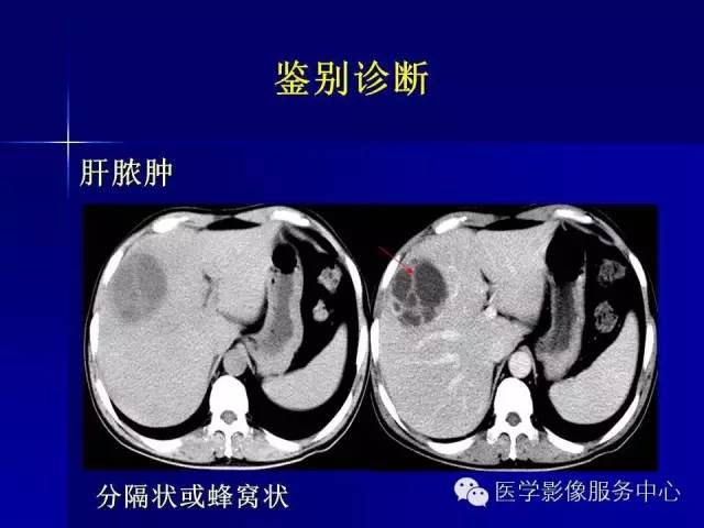 【病例】肝内胆管细胞癌1例CT影像表现与鉴别