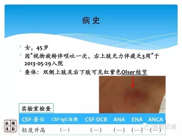 【病例】心房粘液瘤栓塞1例CNS影像表现