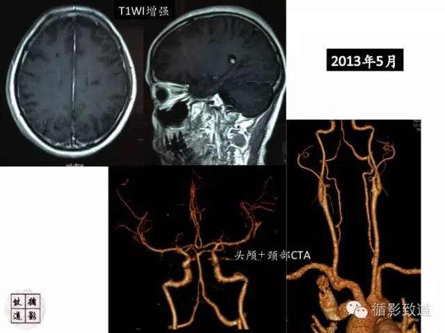 【病例】心房粘液瘤栓塞1例CNS影像表现