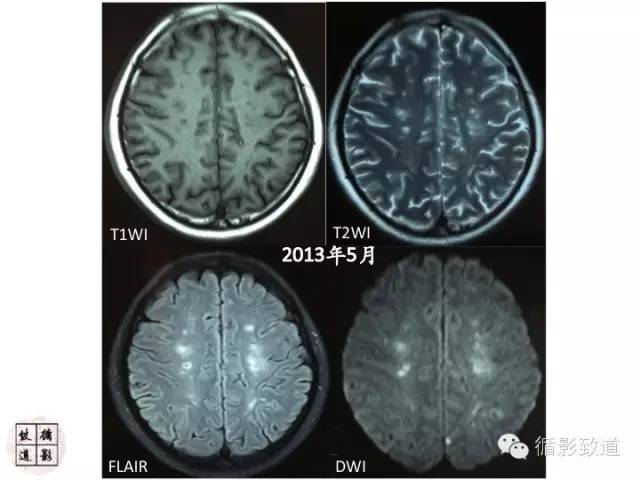 【病例】心房粘液瘤栓塞1例CNS影像表现