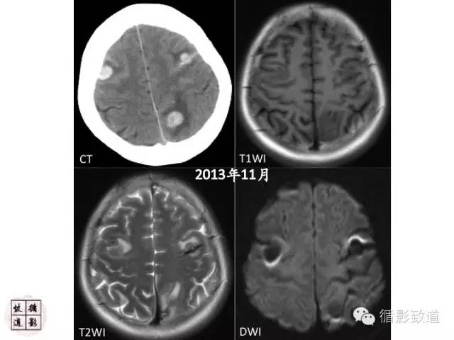 【病例】心房粘液瘤栓塞1例CNS影像表现