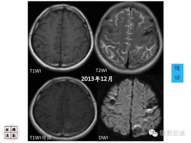 【病例】心房粘液瘤栓塞1例CNS影像表现