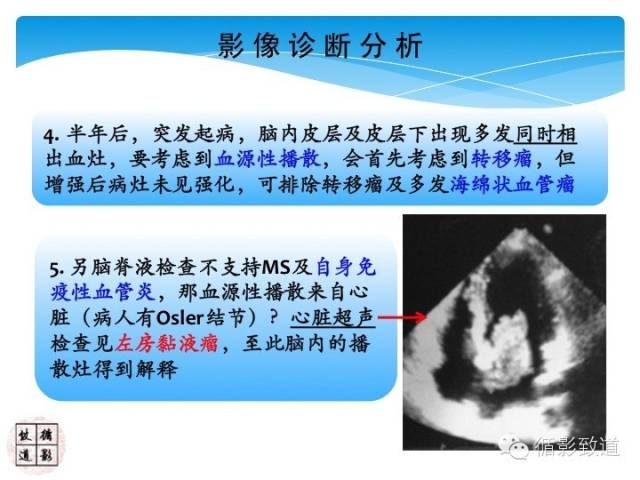 【病例】心房粘液瘤栓塞1例CNS影像表现