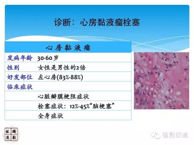 【病例】心房粘液瘤栓塞1例CNS影像表现