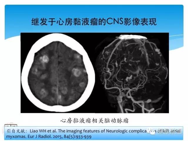 【病例】心房粘液瘤栓塞1例CNS影像表现