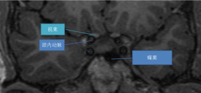 鼻咽癌靶区勾画的相关解剖--海绵窦 鼻咽癌靶区勾画的相关解剖--海绵窦