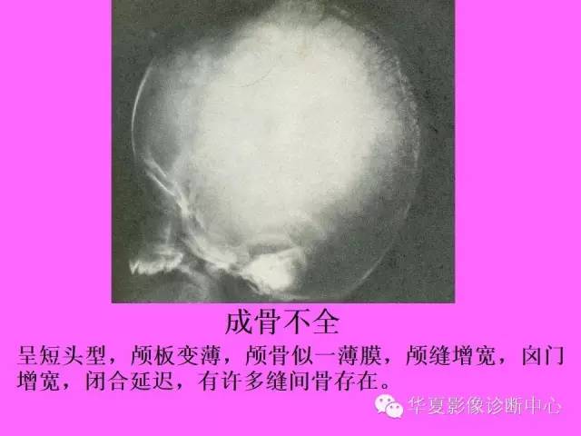 【PPT】骨发育障碍的影像学诊断