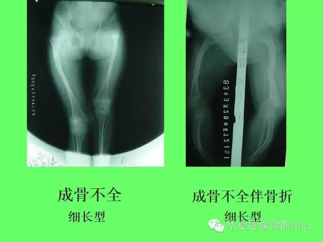 【PPT】骨发育障碍的影像学诊断