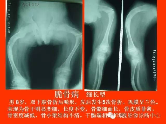 【PPT】骨发育障碍的影像学诊断