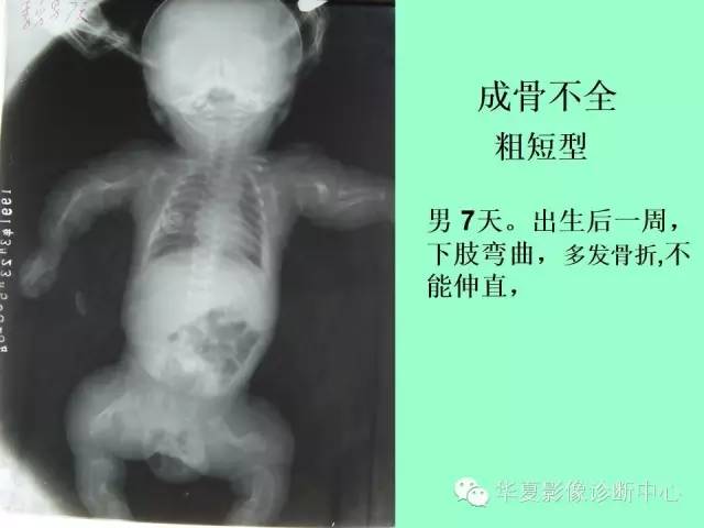 【PPT】骨发育障碍的影像学诊断