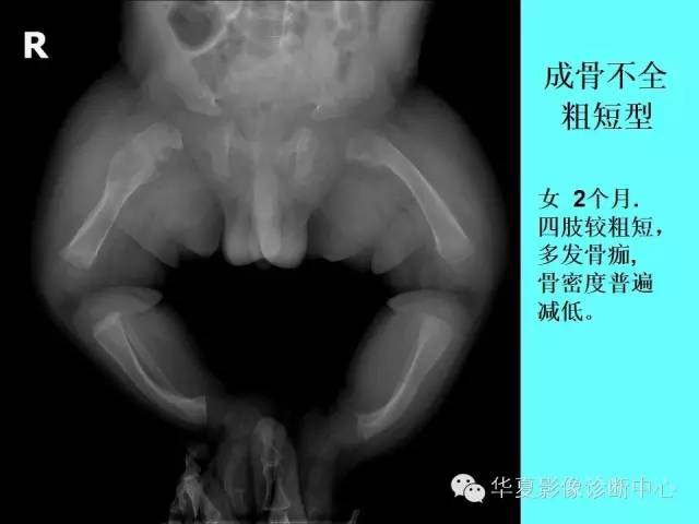【PPT】骨发育障碍的影像学诊断