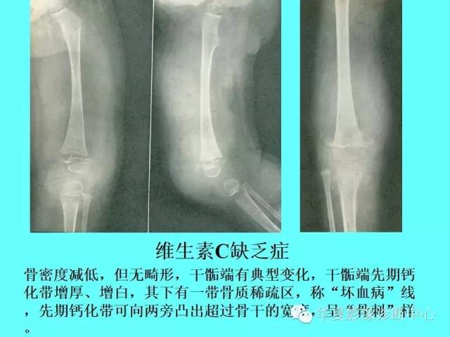 【PPT】骨发育障碍的影像学诊断