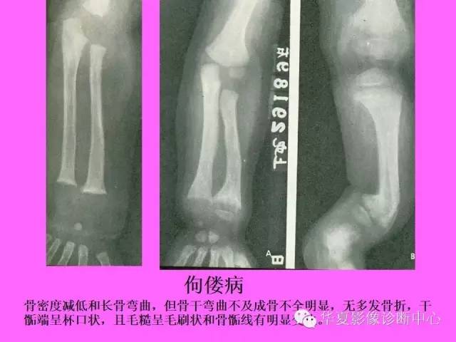 【PPT】骨发育障碍的影像学诊断