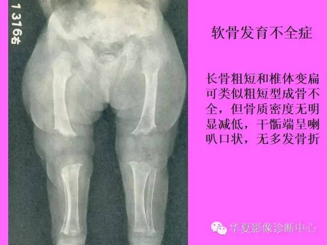 【PPT】骨发育障碍的影像学诊断