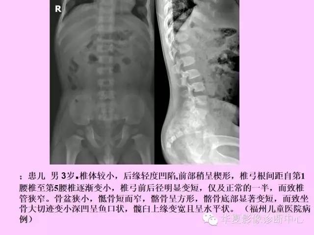 【PPT】骨发育障碍的影像学诊断