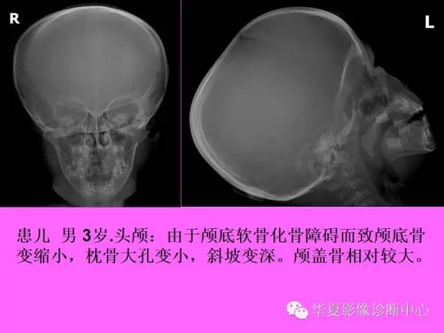 【PPT】骨发育障碍的影像学诊断