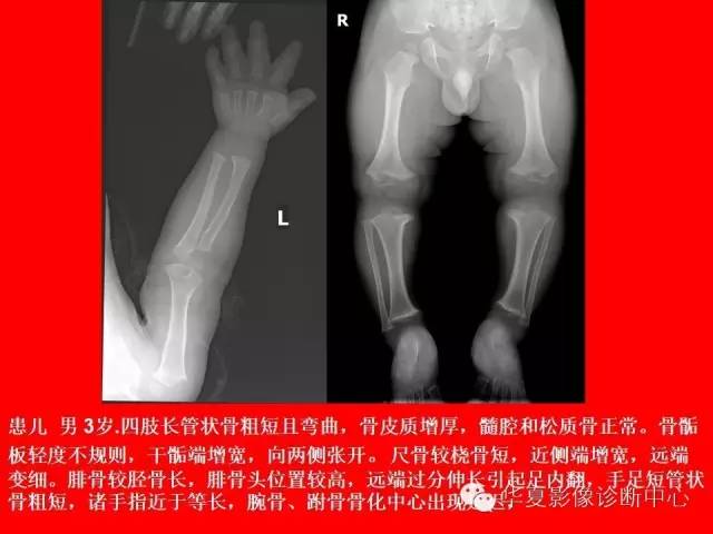 【PPT】骨发育障碍的影像学诊断