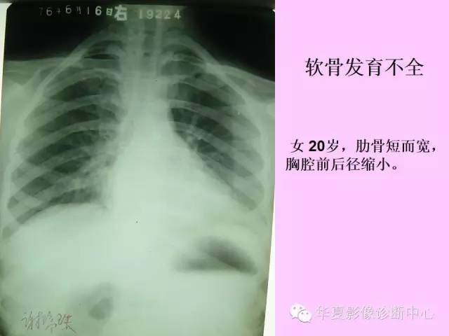 【PPT】骨发育障碍的影像学诊断