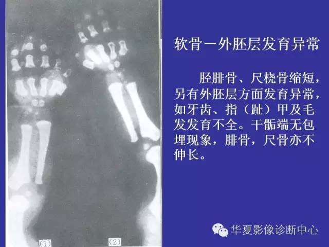 【PPT】骨发育障碍的影像学诊断